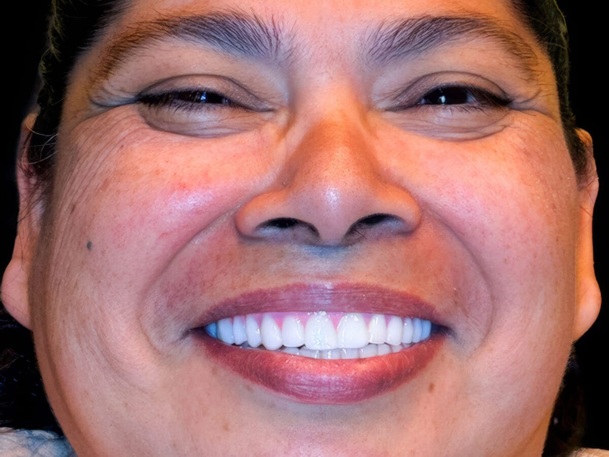 After treatment result for Restoring a Complete Smile