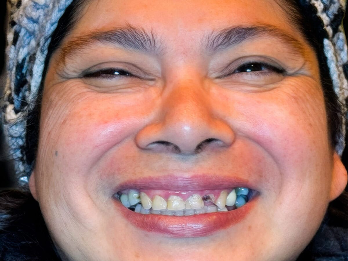 Before treatment condition for Restoring a Complete Smile