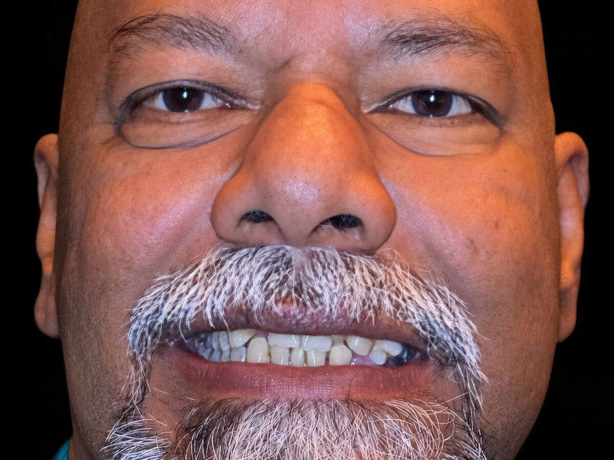 Before treatment condition for Getting a New Smile